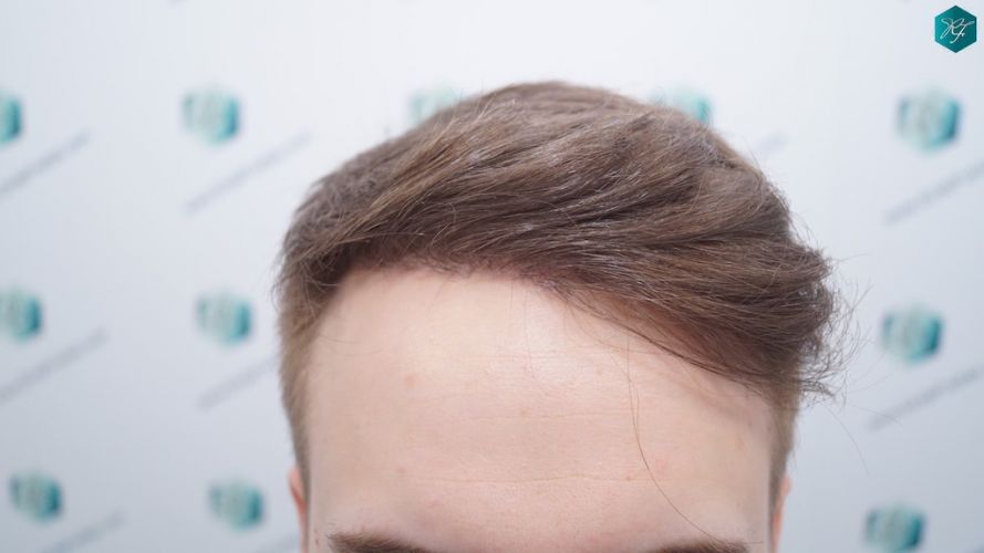 RESULTADOS A LOS 12 MESES evolución trasplante de pelo