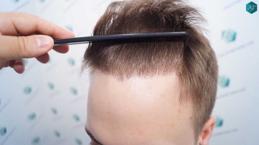 Injerto Capilar Técnica FUE 3097 Folículos (7082 Pelos) 55 trasplante de pelo realizado