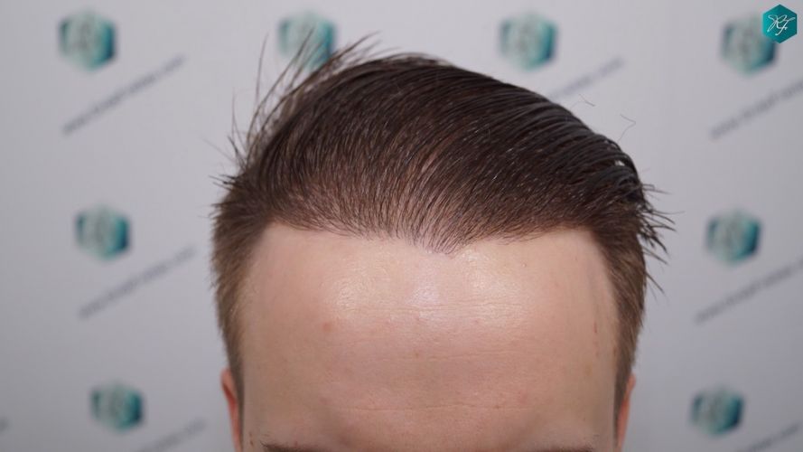 Injerto Capilar Técnica FUE 3097 Folículos (7082 Pelos) 41 evolución trasplante de pelo