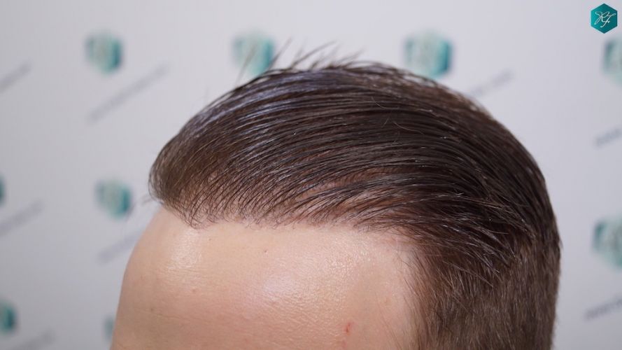 Injerto Capilar Técnica FUE 3097 Folículos (7082 Pelos) 48 trasplante de pelo realizado