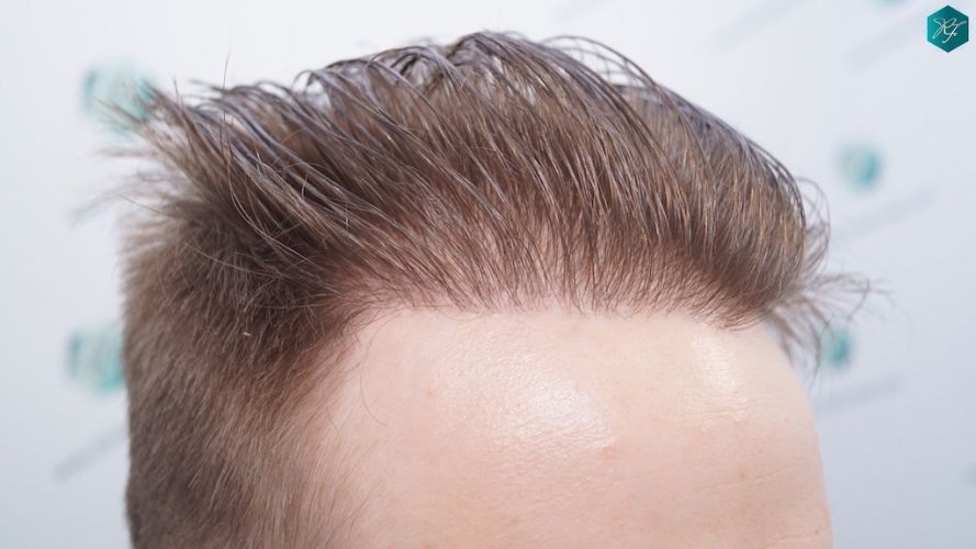 Injerto Capilar Técnica FUE 3097 Folículos (7082 Pelos) 45 implante de pelo en España