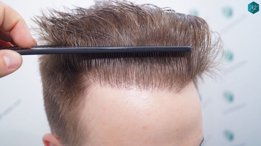 Injerto Capilar Técnica FUE 3097 Folículos (7082 Pelos) 54 implante de pelo en España