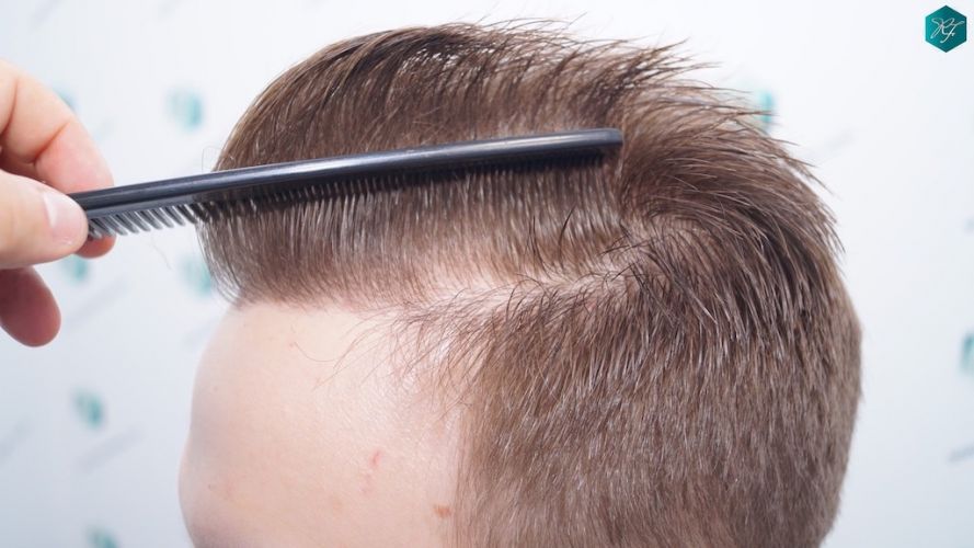 Injerto Capilar Técnica FUE 3097 Folículos (7082 Pelos) 56 implante de pelo en España