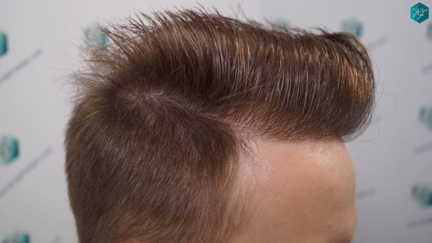Injerto Capilar Técnica FUE 3097 Folículos (7082 Pelos) 47 implante de pelo en España