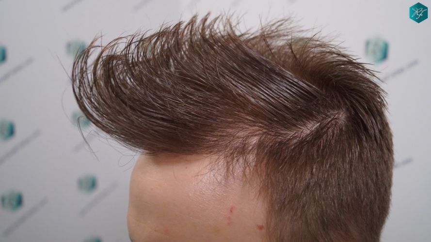 Injerto Capilar Técnica FUE 3097 Folículos (7082 Pelos) 49 implante de pelo en España