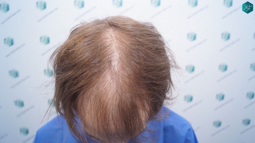 Injerto Capilar Técnica FUE 3097 Folículos (7082 Pelos) 2 implante de pelo en España