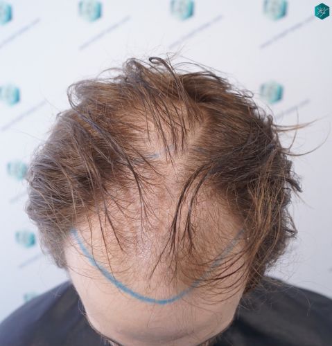 Injerto Capilar Técnica FUE 3097 Folículos (7082 Pelos) 5 clinica capilar valencia