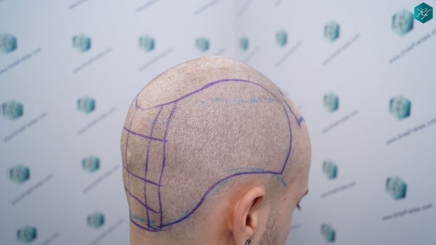 Injerto Capilar Técnica FUE 3097 Folículos (7082 Pelos) 10 diseño linea trasplante de pelo