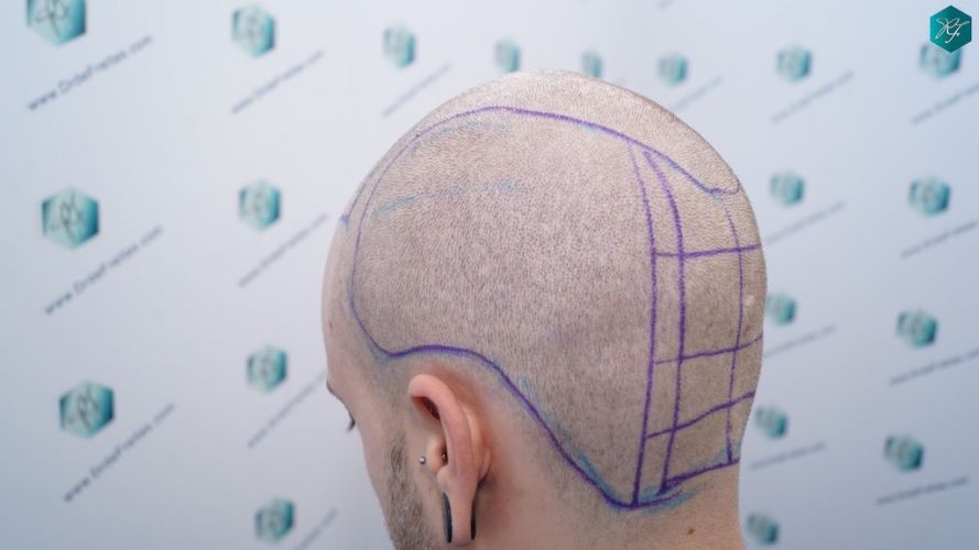 Injerto Capilar Técnica FUE 3097 Folículos (7082 Pelos) 9 diseño linea trasplante de pelo