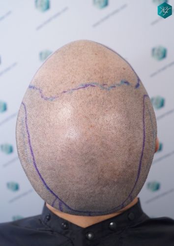 Injerto Capilar Técnica FUE 3097 Folículos (7082 Pelos) 11 implante de pelo en España