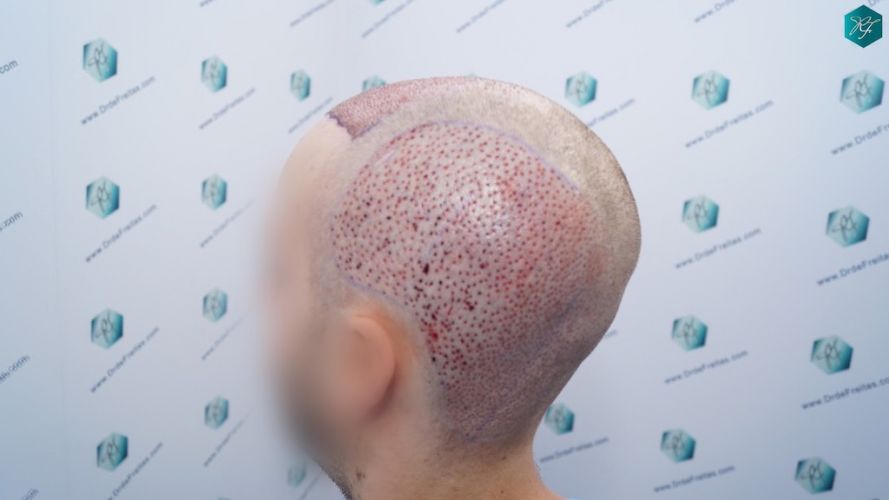 Injerto Capilar Técnica FUE 3097 Folículos (7082 Pelos) 19 Injerto de pelo en España