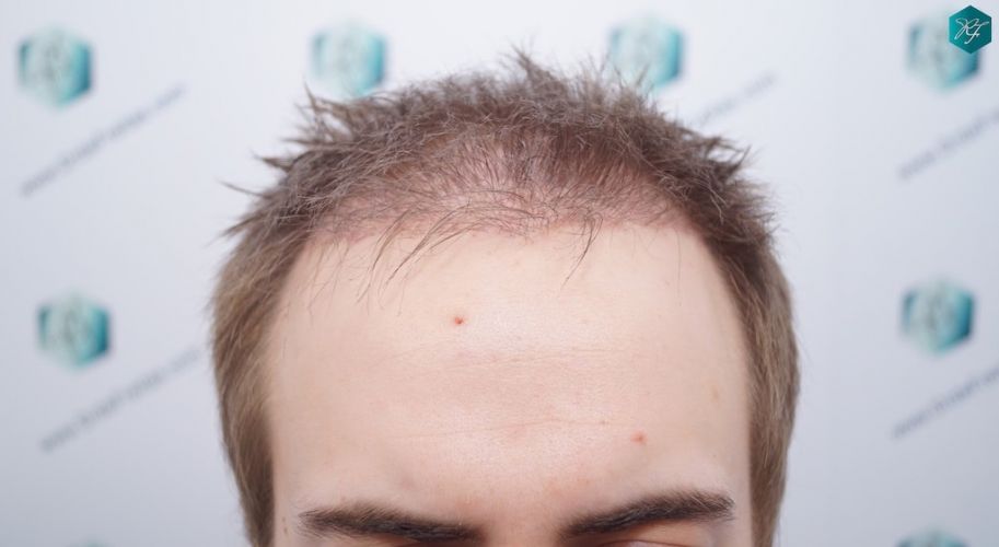RESULTADOS A LOS 3 MESES evolución trasplante de pelo