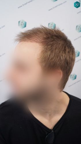 Injerto Capilar Técnica FUE 3097 Folículos (7082 Pelos) 24 Injerto de pelo en España