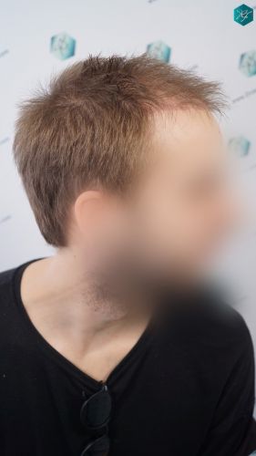 Injerto Capilar Técnica FUE 3097 Folículos (7082 Pelos) 23 implante de pelo