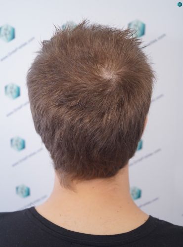Injerto Capilar Técnica FUE 3097 Folículos (7082 Pelos) 37 implante de pelo en España