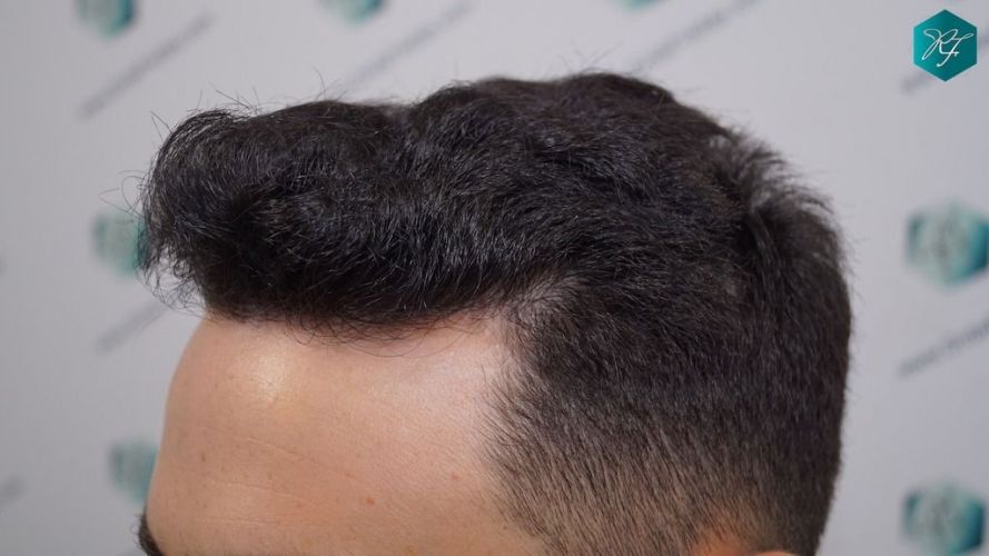 Injerto Capilar Técnica FUE 2046 Grafts (5983 Pelos) 35 tecnica fue en España