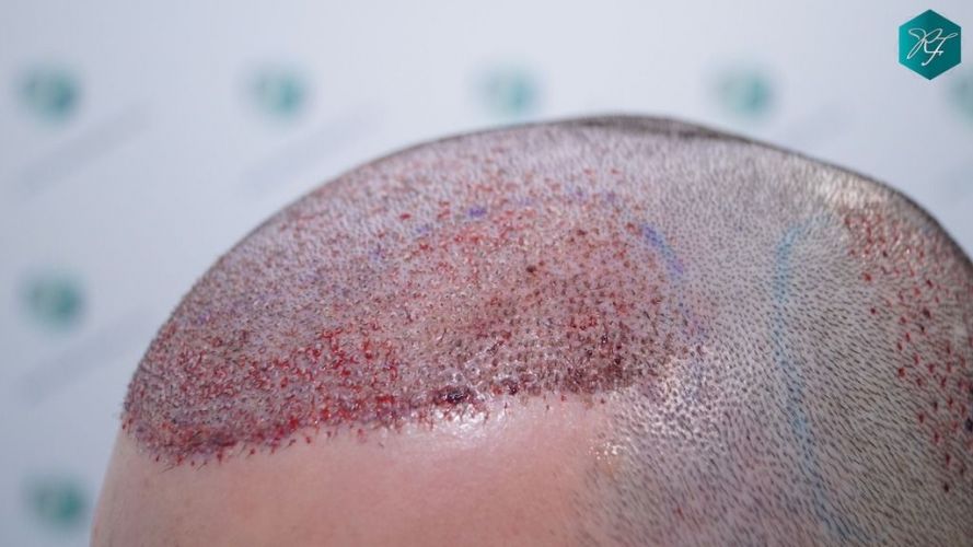 Injerto Capilar Técnica FUE 2046 Grafts (5983 Pelos) 23 tecnica fue en España