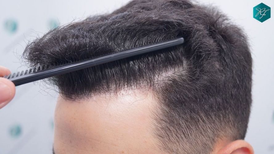 Injerto Capilar Técnica FUE 2046 Grafts (5983 Pelos) 41 Implante de pelo en España