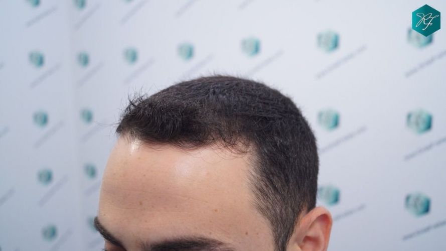 Injerto Capilar Técnica FUE 2046 Grafts (5983 Pelos) 6 tecnica fue