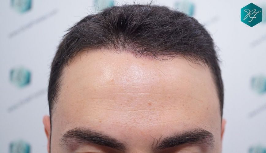 Injerto Capilar Técnica FUE 2046 Grafts (5983 Pelos) 1 tecnica Fue resultados