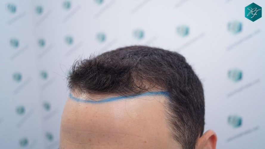 Injerto Capilar Técnica FUE 2046 Grafts (5983 Pelos) 13 tecnica Fue resultados