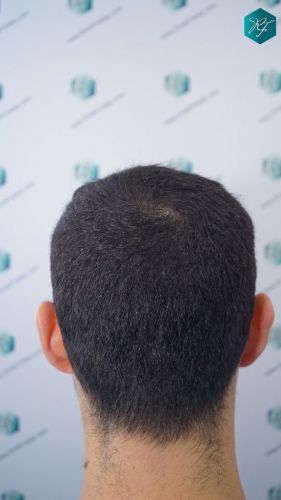 Injerto Capilar Técnica FUE 2046 Grafts (5983 Pelos) 38 tecnica Fue resultados