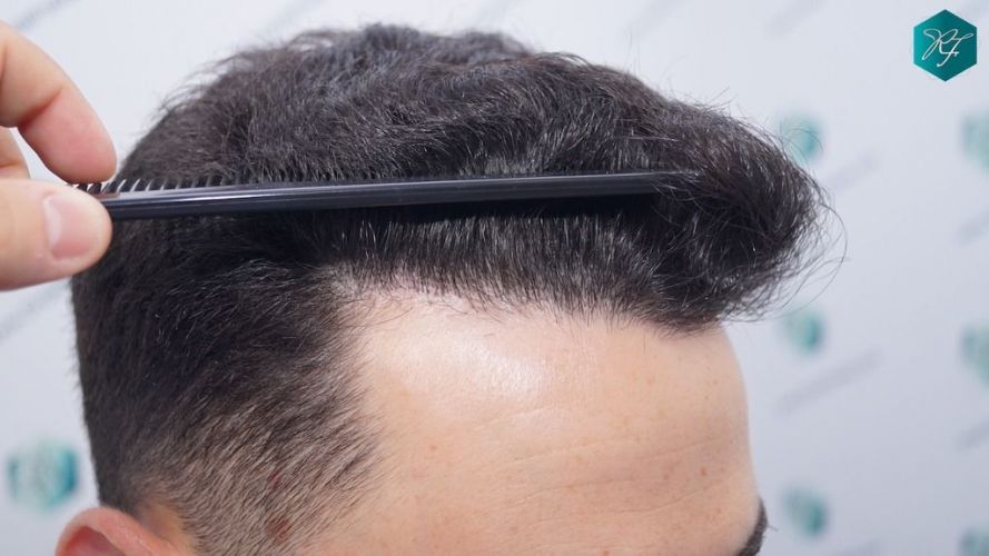 Injerto Capilar Técnica FUE 2046 Grafts (5983 Pelos) 40 tecnica Fue resultados