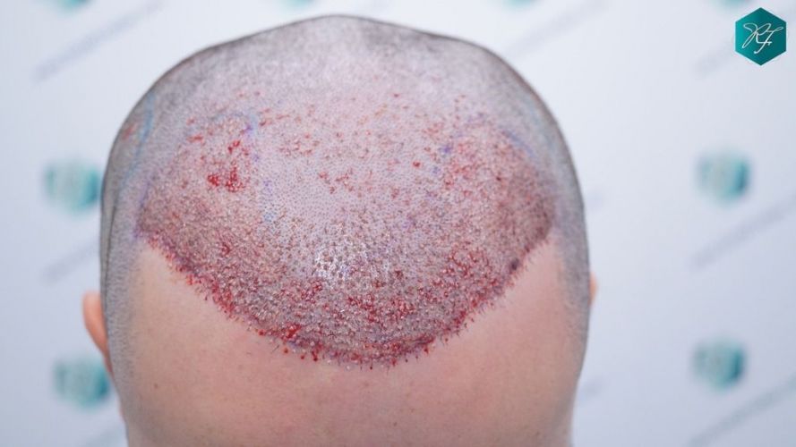 Injerto Capilar Técnica FUE 2046 Grafts (5983 Pelos) 26 tecnica Fue resultados