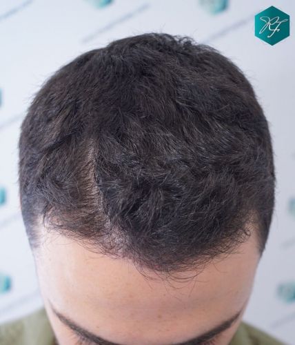 Injerto Capilar Técnica FUE 2046 Grafts (5983 Pelos) 2 tecnica fue en España