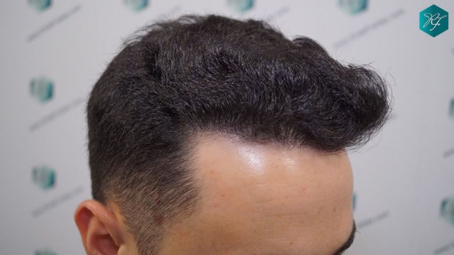 Injerto Capilar Técnica FUE 2046 Grafts (5983 Pelos) 32 proceso injerto capilar