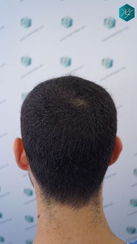 Injerto Capilar Técnica FUE 2046 Grafts (5983 Pelos) 37 injerto capilar resultados
