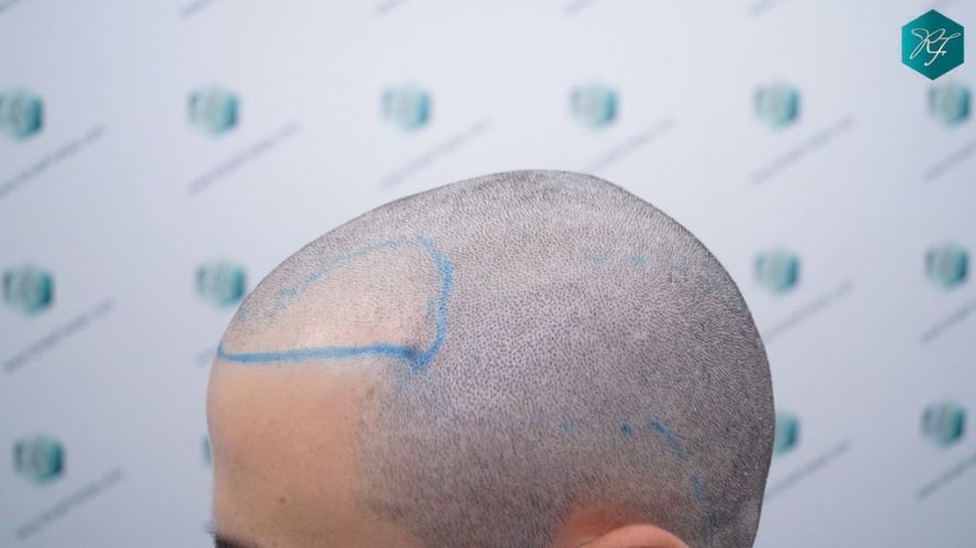 Injerto Capilar Técnica FUE 2046 Grafts (5983 Pelos) 17 injerto capilar resultados