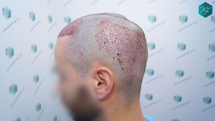 Injerto Capilar Técnica FUE 2046 Grafts (5983 Pelos) 25 injerto capilar resultados