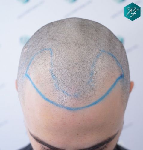 Injerto Capilar Técnica FUE 2046 Grafts (5983 Pelos) 15 injerto capilar resultados