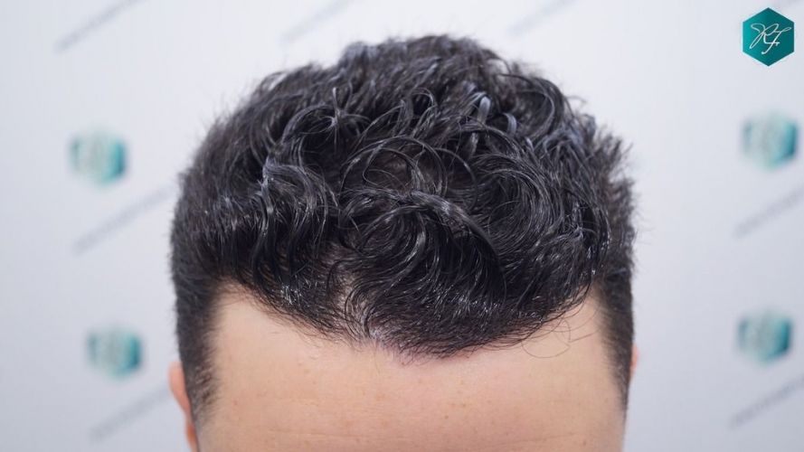 Injerto Capilar Técnica FUE 2046 Grafts (5983 Pelos) 29 injerto capilar resultados