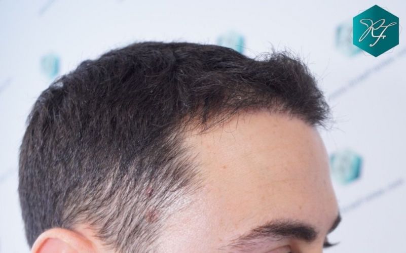 Injerto Capilar Técnica FUE 2046 Grafts (5983 Pelos) 5 injerto capilar resultados