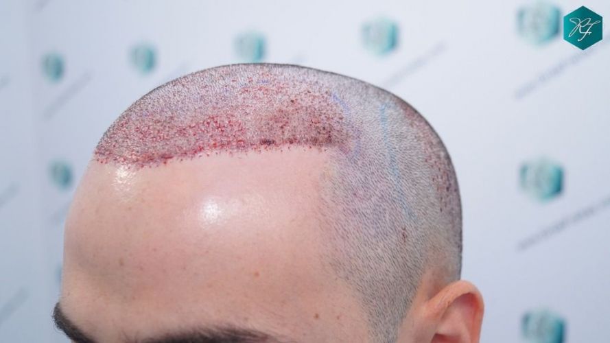 Injerto Capilar Técnica FUE 2046 Grafts (5983 Pelos) 22 tecnica fue en España