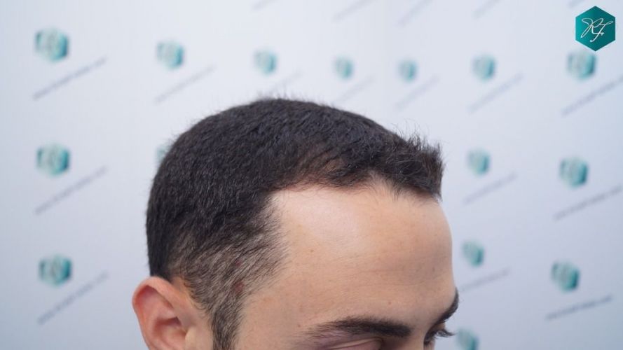 Injerto Capilar Técnica FUE 2046 Grafts (5983 Pelos) 4 injerto de pelo