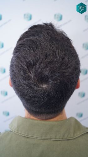 Injerto Capilar Técnica FUE 2046 Grafts (5983 Pelos) 8 injerto de pelo en coronilla