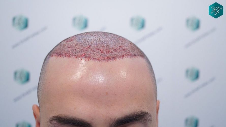 TRASPLANTE INJERTO CAPILAR trasplante de pelo