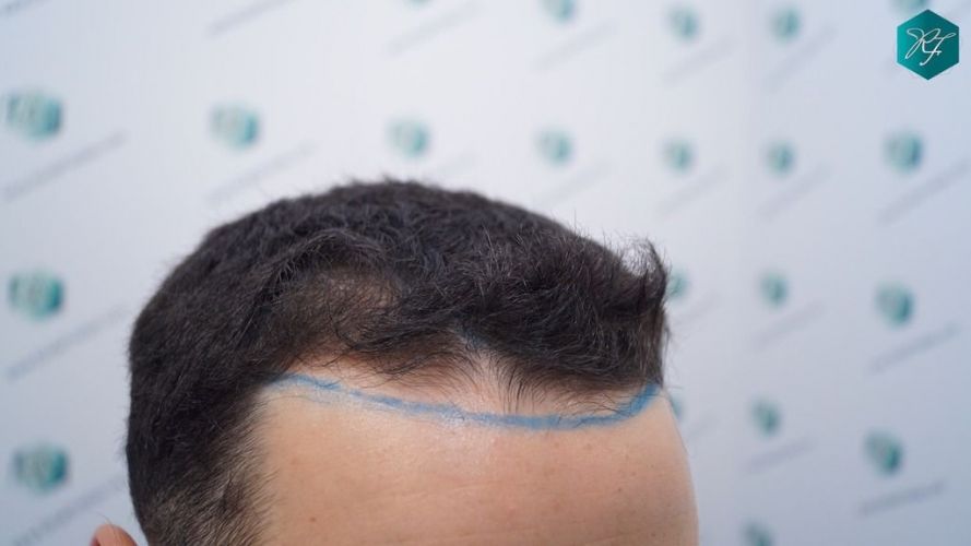 Injerto Capilar Técnica FUE 2046 Grafts (5983 Pelos) 11 trasplante de pelo