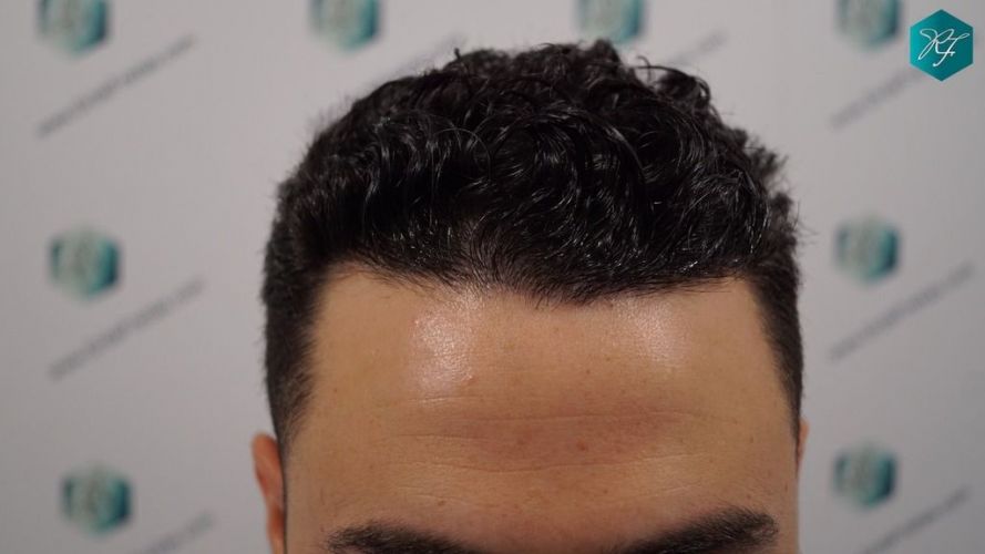 Injerto Capilar Técnica FUE 2046 Grafts (5983 Pelos) 28 trasplante de pelo