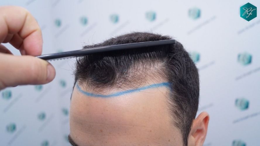 Injerto Capilar Técnica FUE 2046 Grafts (5983 Pelos) 12 trasplante de pelo