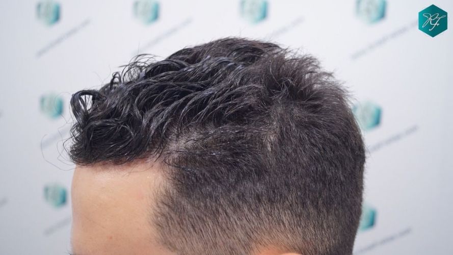 Injerto Capilar Técnica FUE 2046 Grafts (5983 Pelos) 36 trasplante de pelo