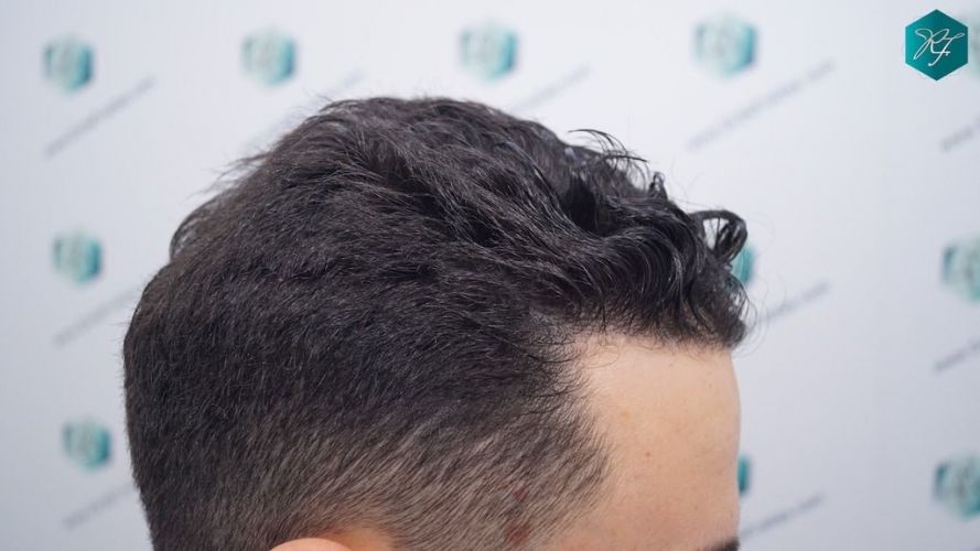 Injerto Capilar Técnica FUE 2046 Grafts (5983 Pelos) 33 trasplante de pelo