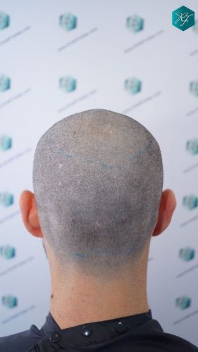 Injerto Capilar Técnica FUE 2046 Grafts (5983 Pelos) 19 trasplante de pelo