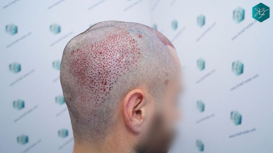 Injerto Capilar Técnica FUE 2046 Grafts (5983 Pelos) 24 trasplante de pelo