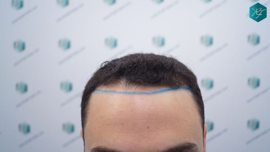 DISEÑO LÍNEA INJERTO CAPILAR trasplante de pelo