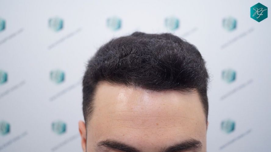 RESULTADO A LOS 12 MESES trasplante de pelo