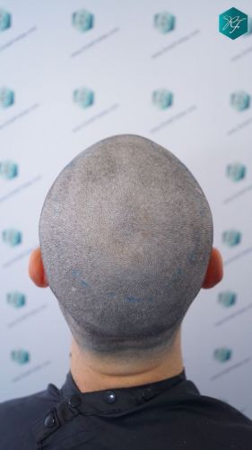 Injerto Capilar Técnica FUE 2046 Grafts (5983 Pelos) 18 injerto capilar tecnica fue